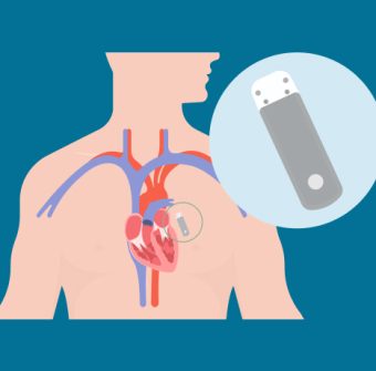 Loop_Recorder_Implantation