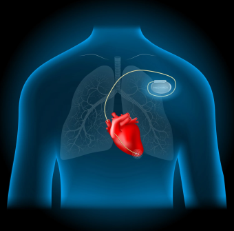 Pacemaker