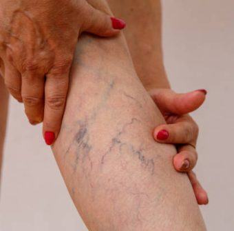 varicose veins of eldelry woman. varicose veins of eldelry woman.