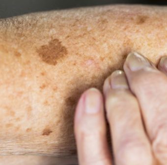 vein-skin-dis vein-skin-dis